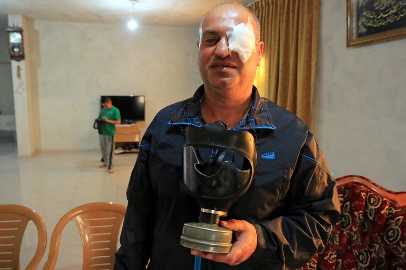 Xinhua photographer Nidal Shtayyeh, who was shot in the thigh by a rubber-coated metal bullet on April 19 while covering the Israeli army crackdown on the weekly protests in Kufr Qaddoum, is seen here after having been shot in the eye by an Israeli soldier while he was covering a demonstration in June 2015.
