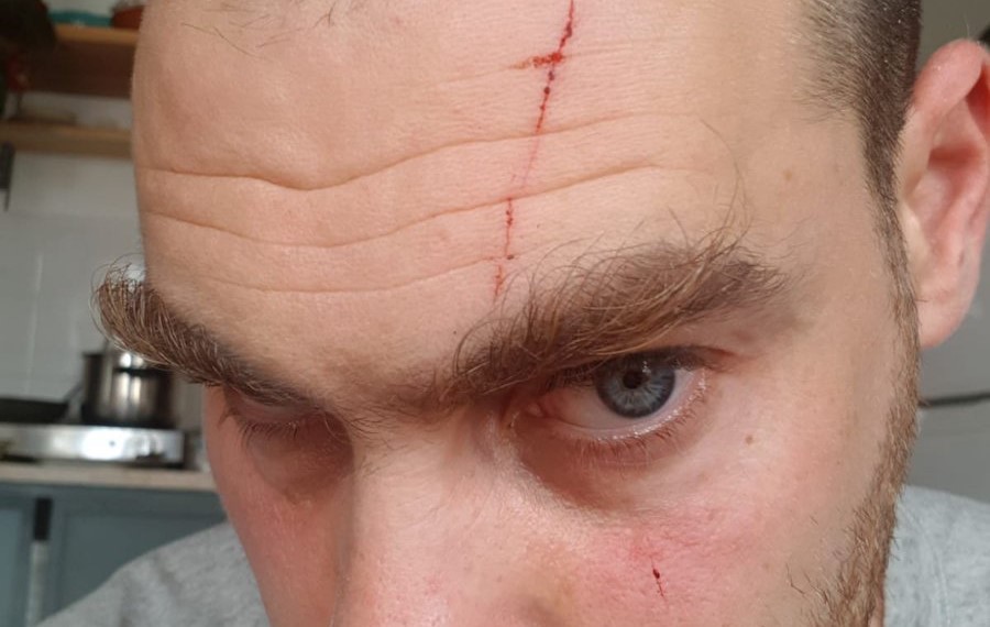 Anti-occupation Activist Jonathan Pollak after he was attacked by right-wing ruffians in Tel Aviv on Sunday, July 7