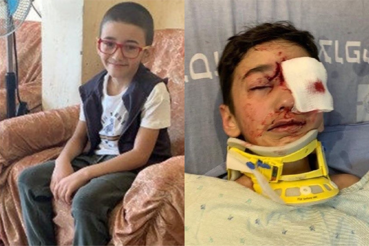 Malek Issa, 9-year-old resident of occupied al-Issawiya, before and after he was shot by Israeli police